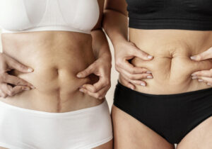 duas mulheres segurando barriga com diástase abdominal